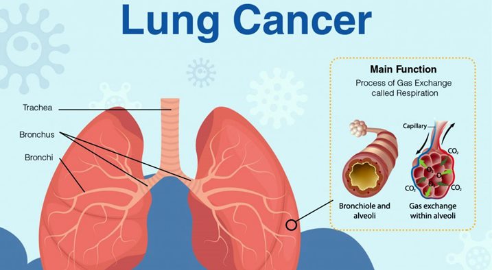 Lungs cancer