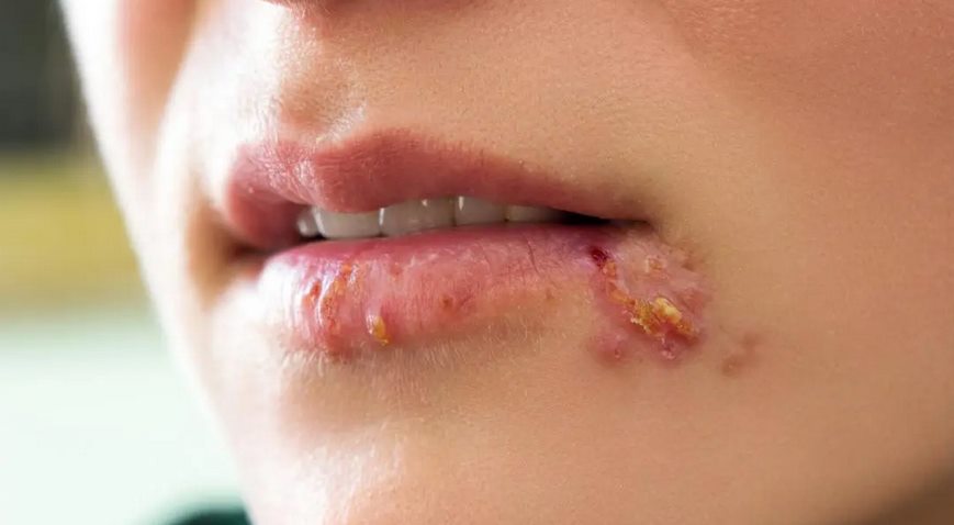 Herpes virus