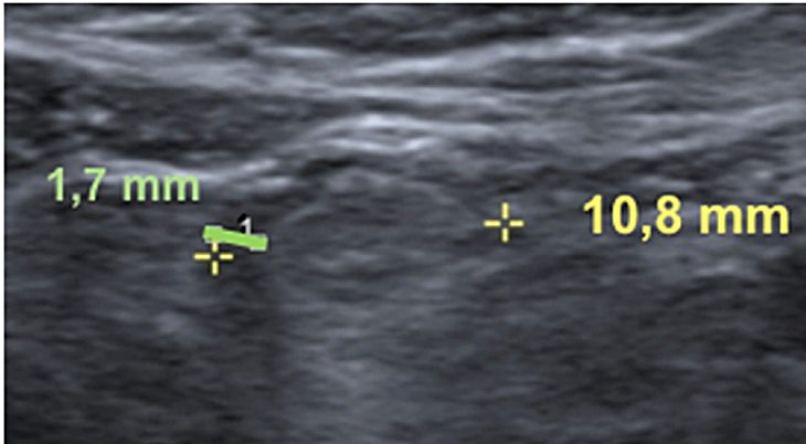 Axillary glands metastasis