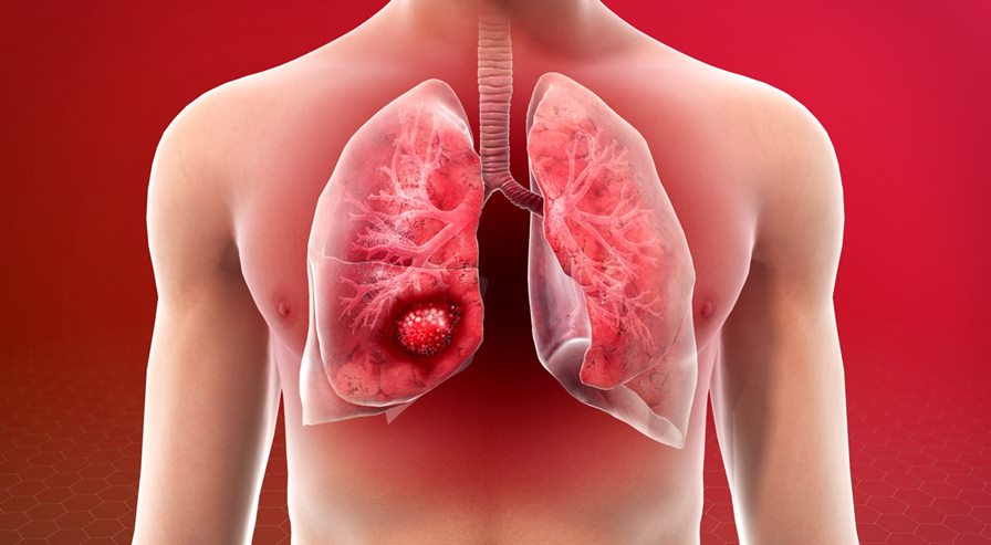 Lungs cancer